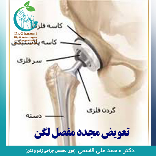 تعويض مجدد مفصل لگن