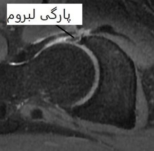ام ار ارتروگرافی –پارگی لبروم 