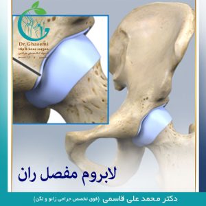 لابروم-مفصل-ران