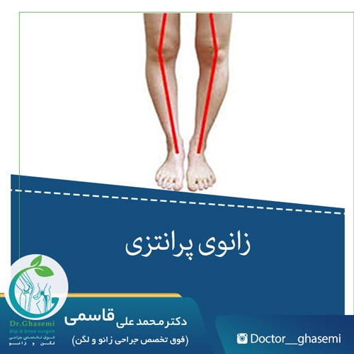 زانوی پرانتزی