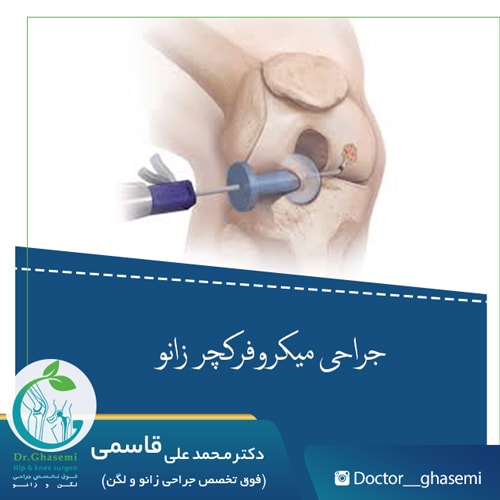 جراحی میکروفرکچر زانو