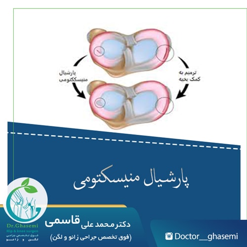 پارشیال منیسکتومی