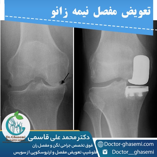 تعویض مفصل نیمه زانو