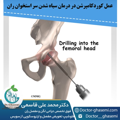 عمل کوردکامپرشن در درمان سیاه شدن سر استخوان ران
