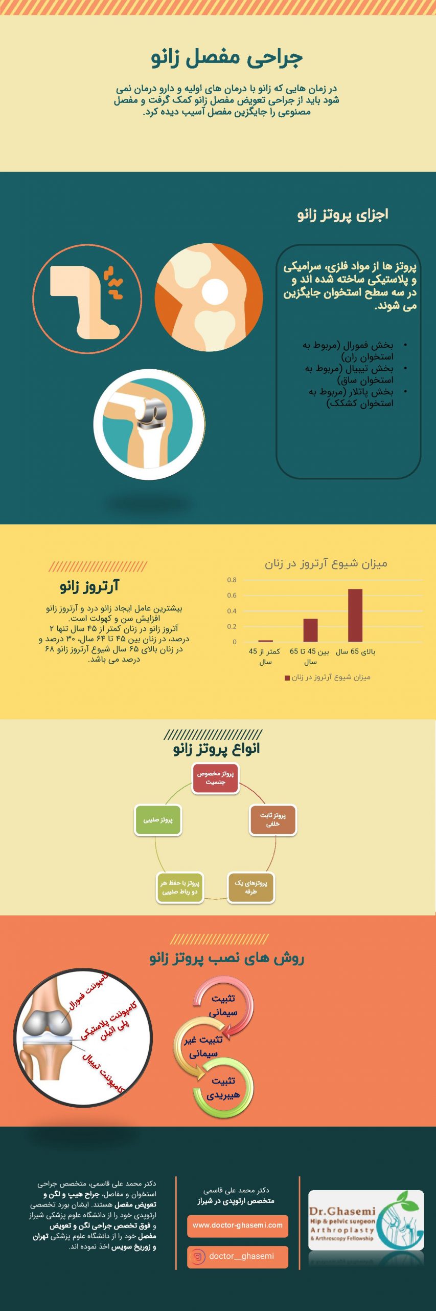 اینفوگرافیک پروتز زانو