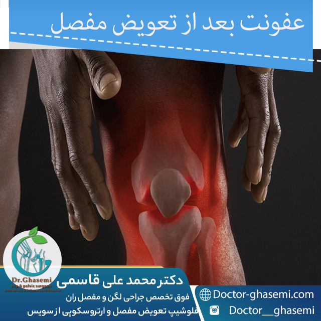 عفونت بعد از تعویض مفصل