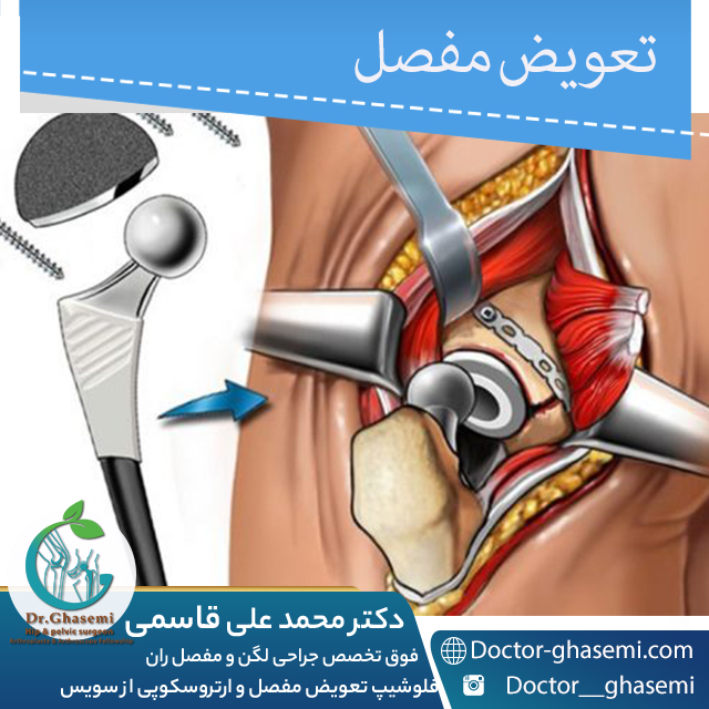 تعویض مفصل لگن بعد از عفونت