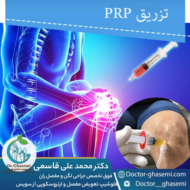 تزریق پی ار پی برای درمان آرتریت 