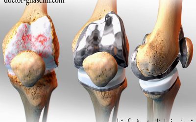 تعویض کامل مفصل زانو با کمترین میزان تهاجم