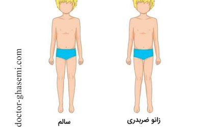 زانو ضربدری؛ علائم تا درمان قطعی