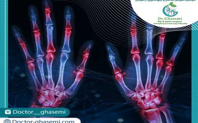 علت تا درمان روماتیسم مفصلی