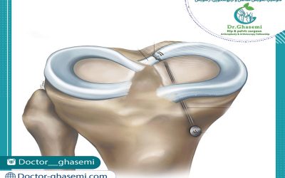 ترمیم ریشه‌ی منیسک
