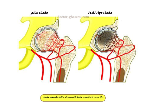 تاثیر کورتون بر سیاه  شدن مفصل