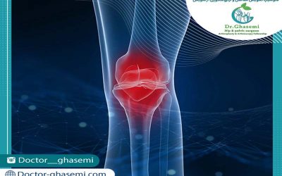 نکات مهم قبل از تعویض مفصل زانو