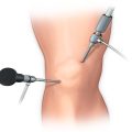 اقدامات لازم قبل از عمل تعویض مفصل و آرتروسکوپی
