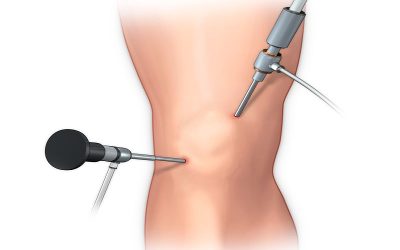 اقدامات لازم قبل از عمل تعویض مفصل و آرتروسکوپی