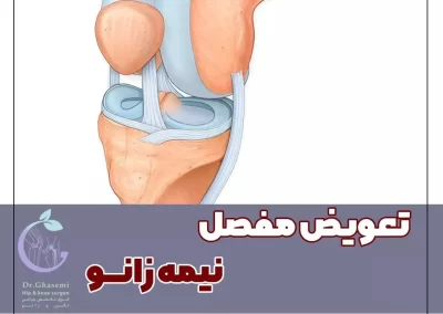 تعویض مفصل نیمه زانو