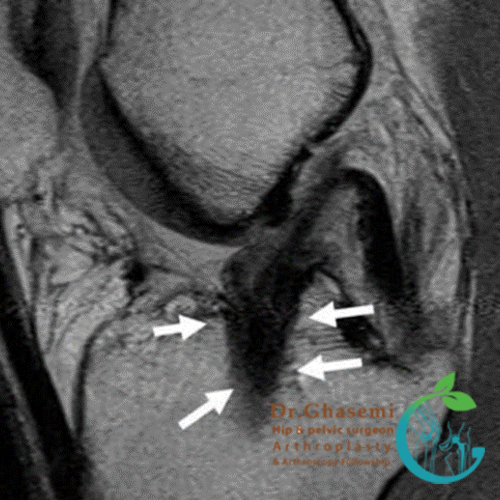 پیوند ACL که بیش از اندازه در قسمت مرکزی استخوان ساق پا قرار گرفته است.