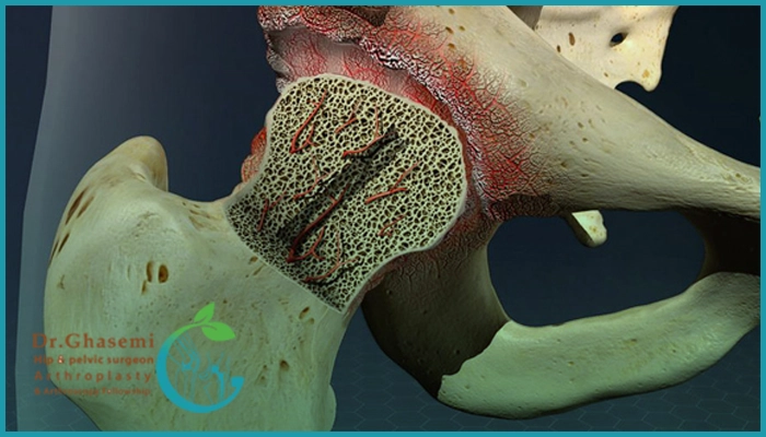 سیاه شدن استخوان لگن چیست؟