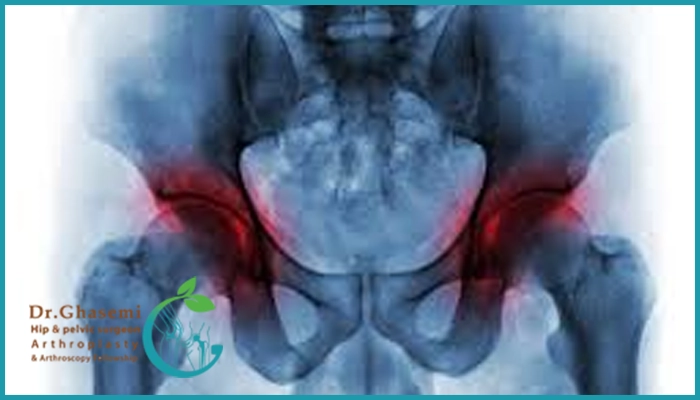 علائم سیاه شدن استخوان لگن (نکروز آواسکولار)