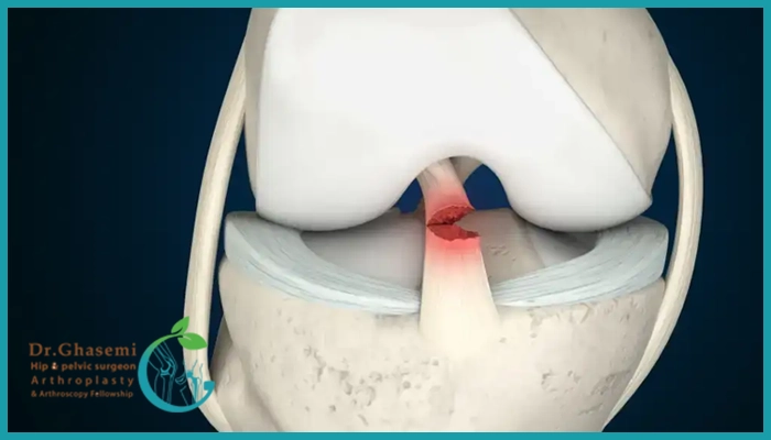 رباط صلیبی قدامی (ACL) چیست و چه وظیفه‌ای دارد؟