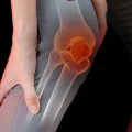 بازسازی رباط صلیبی قدامی در نوجوانان