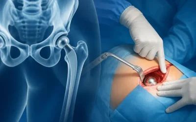 چرا همه جراحان تعویض مفصل لگن را از جلو انجام نمیدهند؟